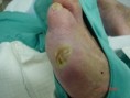 /album/galeria-de-fotos/les%c3%a3o%20cronica%20infectada%20a%20partir%20de%20trauma%20por%20cal%c3%a7ado%20inadequado-jpg/